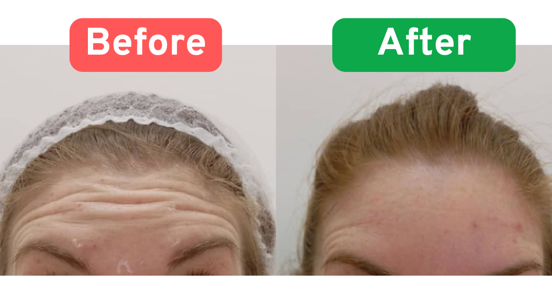Botox treatment before and after results
