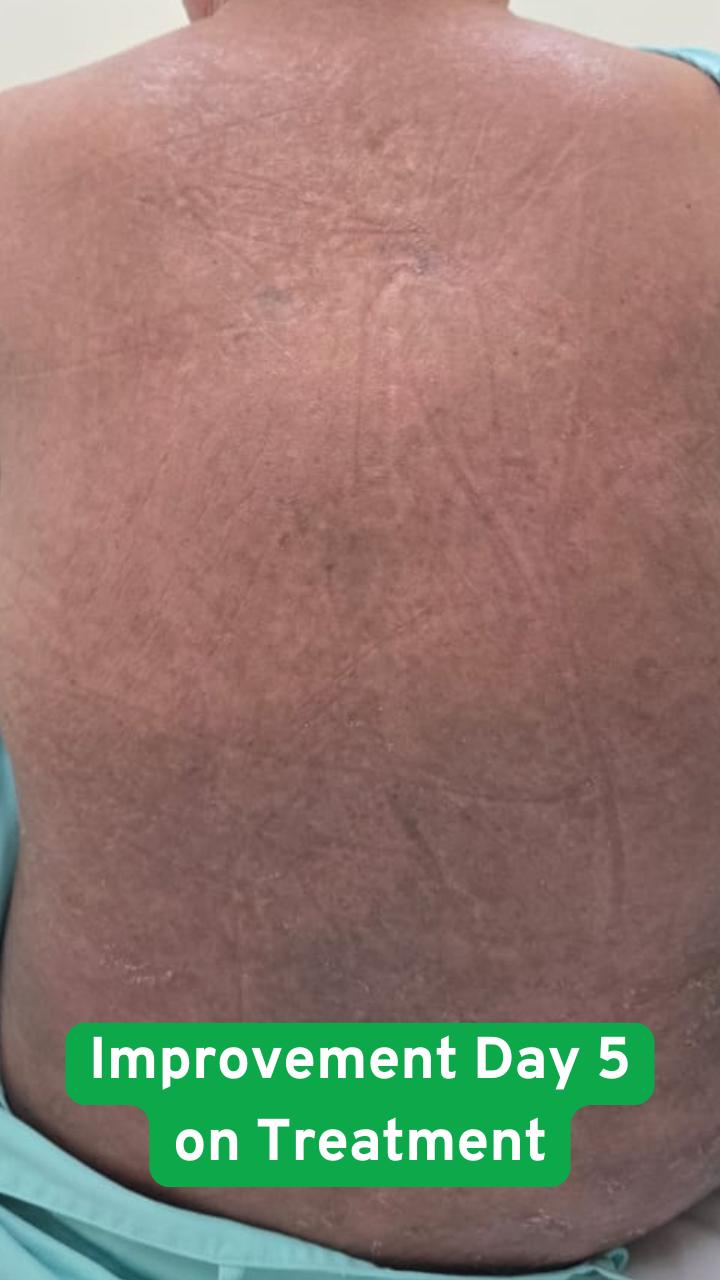 Eczema after treatment showing improvement